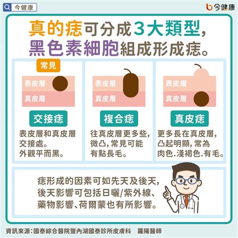 為甚麼會長痣|是痣？皮膚癌？還是什麼？常見Q&A解惑！醫教揪出「。